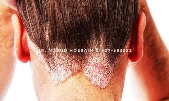 Psoriasis and Skin Disease Homeo Treatment