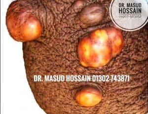 পুরুষের অণ্ডকোষ রোগের হোমিও চিকিৎসা | Homeo treatment of scrotum disease