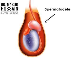 পুরুষের অণ্ডকোষ রোগের হোমিও চিকিৎসা | Homeo treatment of scrotum disease