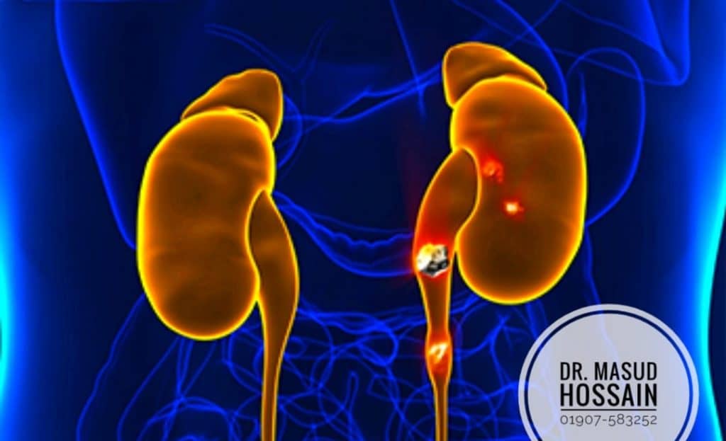 কিডনি পাথরের হোমিও চিকিৎসা । Homeo Treatment of kidney stone .