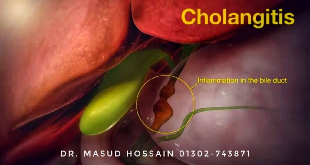 কোলানজাইটিস Cholangitis homeo treatment