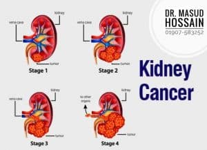ক্রনিক কিডনি ডিসিজ Chronic kidney disease ( CKD )