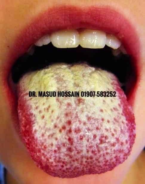 ওরাল ক্যান্ডিডিয়াসিস হোমিওপ্যাথিক চিকিৎসা। Oral candidiasis homeo treatment