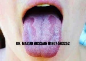 ওরাল ক্যান্ডিডিয়াসিস হোমিওপ্যাথিক চিকিৎসা। Oral candidiasis homeo treatment 