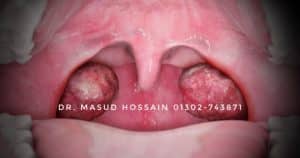 সমস্যায় হোমিও চিকিৎসা Tonsillitis homeo treatment 1