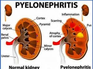 পাইলোনেফ্রাইটিস (pylonephritis ) homeo treatment