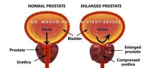 প্রোস্টেট গ্রন্থির বৃদ্ধি - Enlarged Prostate homeopathic treatment