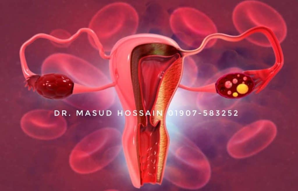 ভারী জরায়ু ( Bulky uterus) homeopathic treatment
