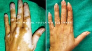 শ্বেত রোগ ( Vitiligo ) হোমিওপ্যাথিক চিকিৎসা - homeo treatment