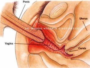 Homeo Treatment of Premature ejarculation