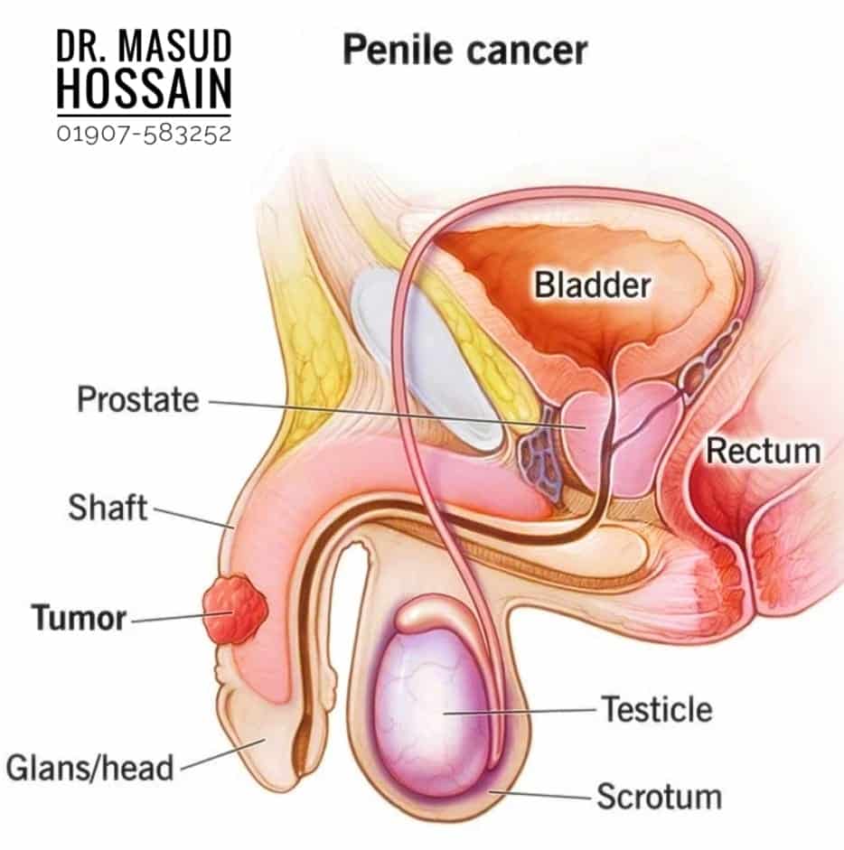  Penile Cancer Homeopathic Treatment