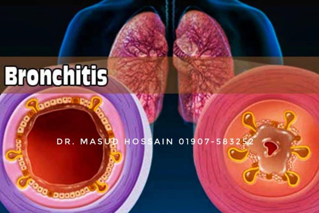 ব্রঙ্কাইটিস হোমিওপ্যাথিক চিকিৎসা Bronchitis Homeopathic Treatment 1