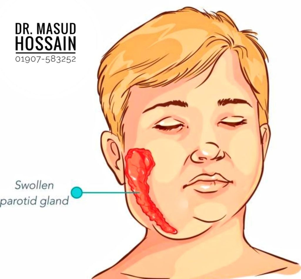মাম্পস - Mumps হোমিওপ্যাথি চিকিৎসা dr. masud hossain