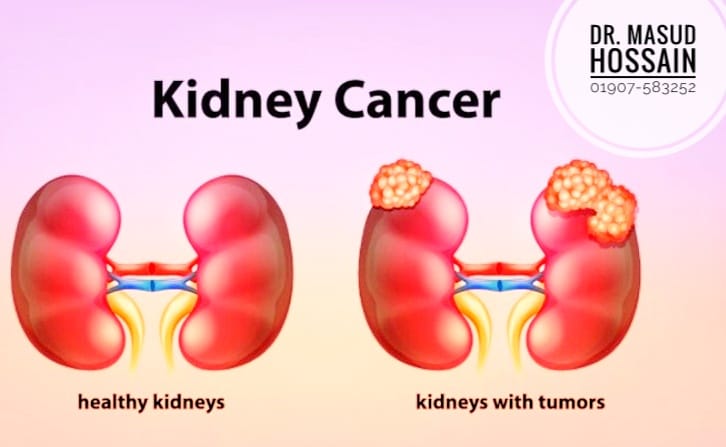 কিডনি ক্যান্সার ( Kidney Cancer ) | ডাঃ মাসুদ হোসেন