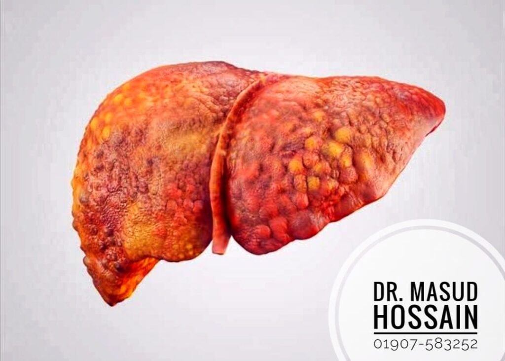 লিভার সিরোসিস |Liver cirrhosis | ডা: মাসুদ হোসেন