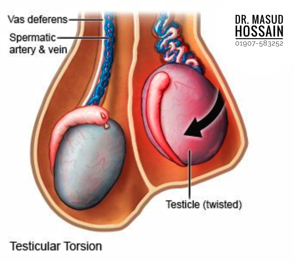 টেস্টিকুলার টর্শন | Testicular Torsion | ডাঃ মাসুদ হোসেন।