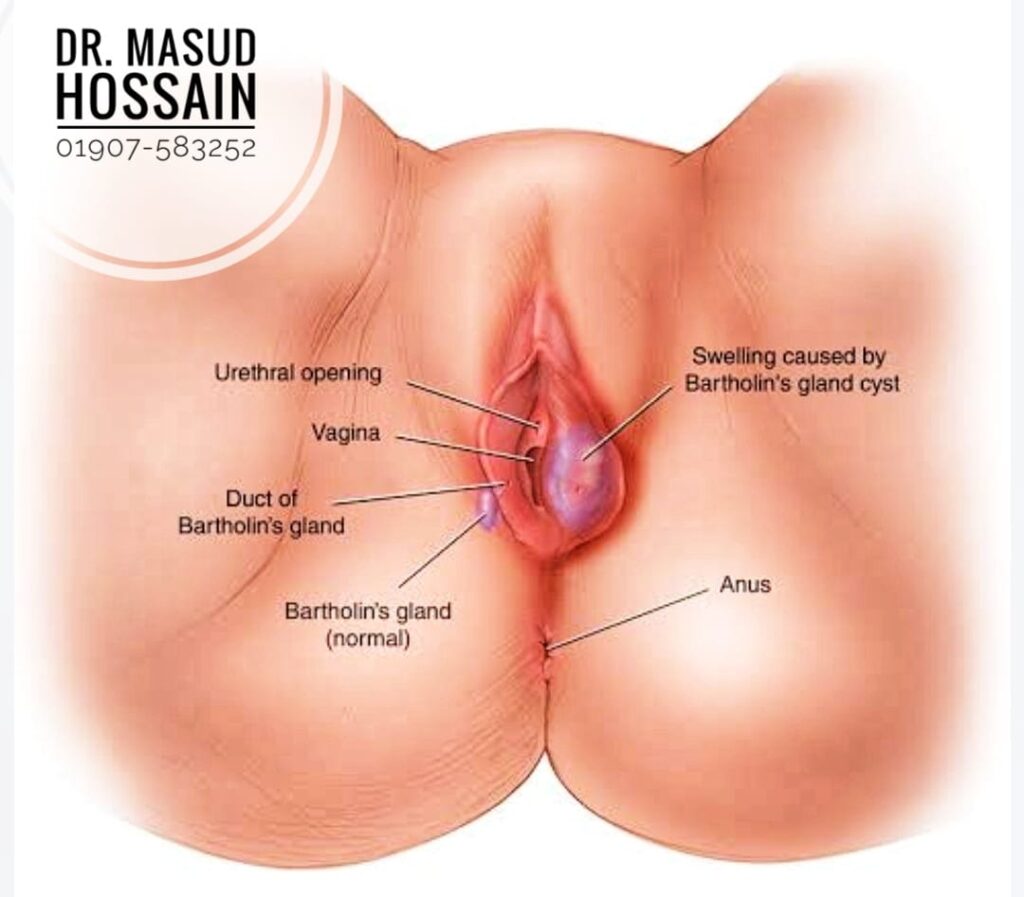 যোনি সিস্ট Vaginal Cysts