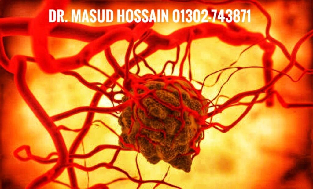 রক্তনালীর টিউমার | Blood Vassel Tumour | ডাঃ মাসুদ হোসেন।