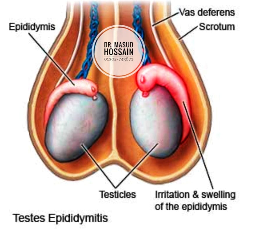 অণ্ডকোষের রোগ-এপিডিডাইমাইটিস | Epididymitis | Dr. Masud Hossain.