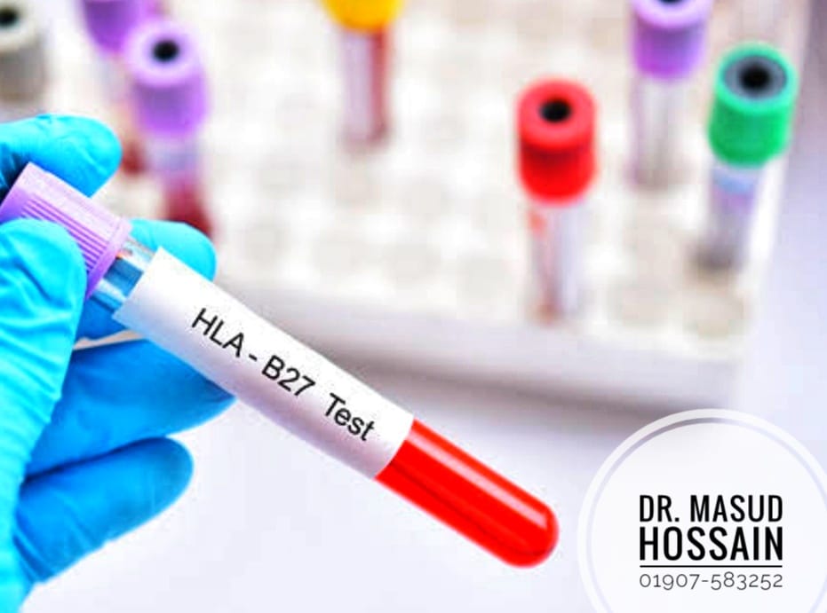 হিউম্যান লিউকোসাইট অ্যান্টিজেন- B27 ( HLA-B27 ) | ডাঃ মাসুদ হোসেন