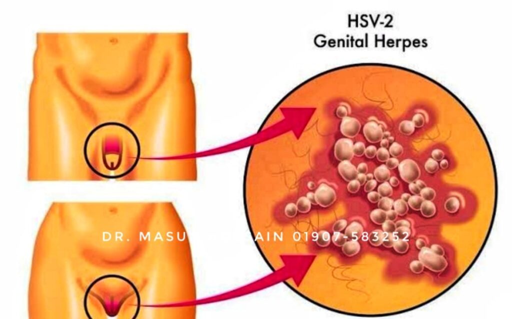 জেনিটাল হারপিস - Genital Herpes কি ? এবং এর হোমিও চিকিৎসা।
