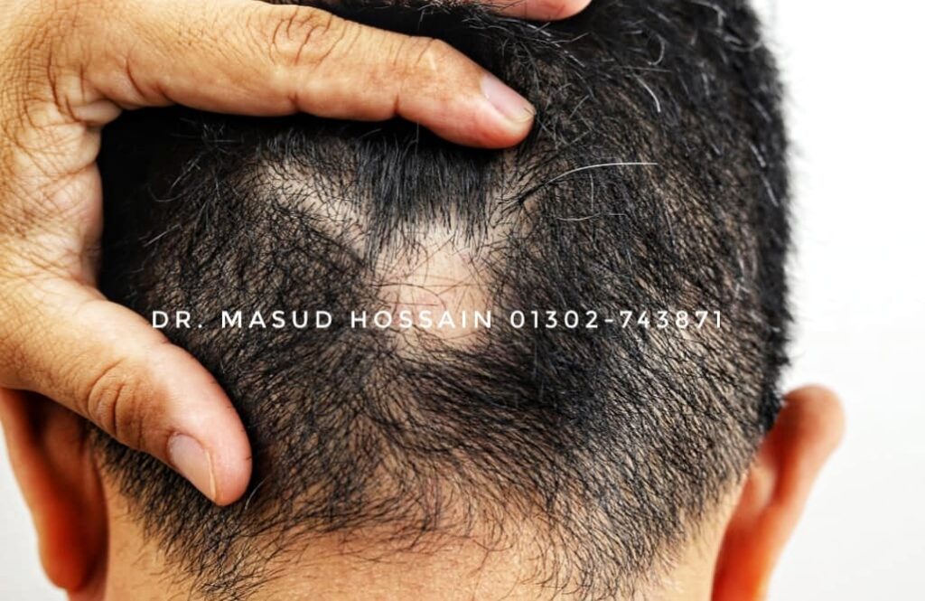 অ্যালোপেশিয়া ( Alopecia ) চুল পড়া | ডাঃ মাসুদ হোসেন।