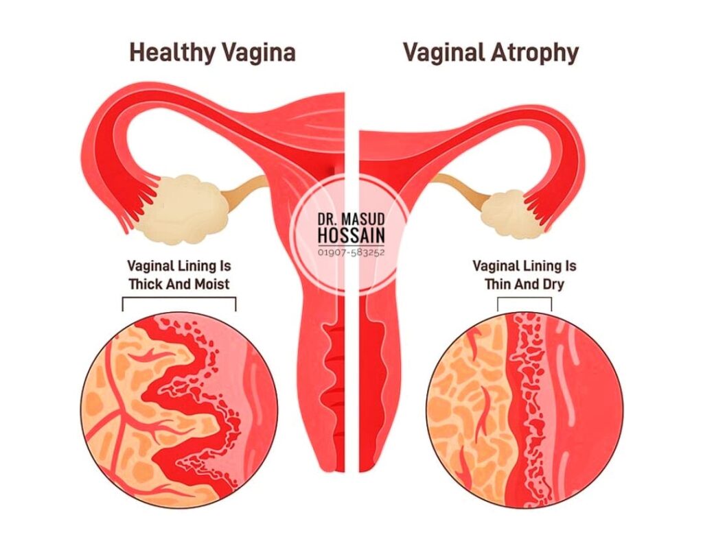 অ্যাট্রোপিক ভ্যাজাইনাইটিস | Vaginal Atrophy | ডাঃ মাসুদ হোসেন।