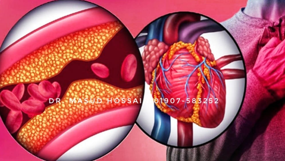 করোনারী অ্যাথেরোস্ক্লেরোসিস | Coronary Atherosclerosis | ডাঃ মাসুদ হোসেন।