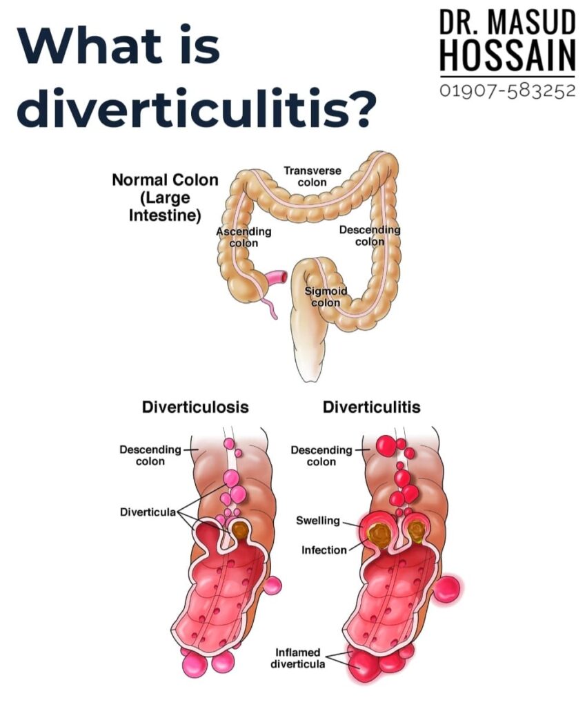 ডাইভারটিকুলাইটিস | Diverticulitis | ডাঃ মাসুদ হোসেন।