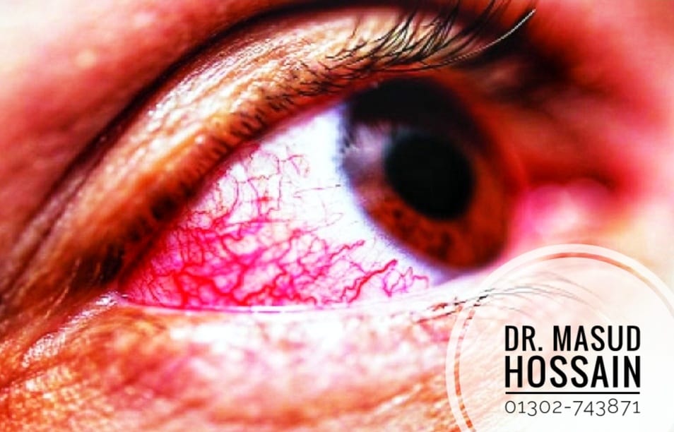 অ্যাকিউট গ্লুকোমা | Acute Glaucoma | ডাঃ মাসুদ হোসেন।