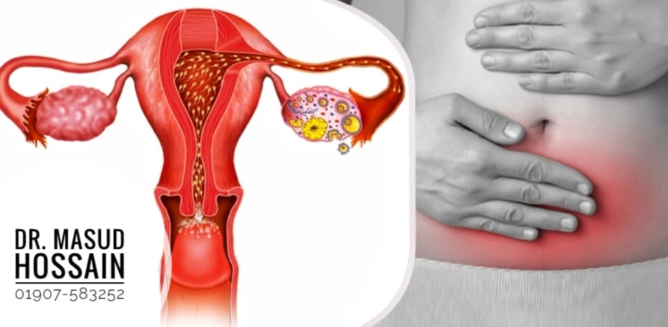 ইডিওপ্যাথিক অ্যাবসেন্স অফ মেন্সট্রুয়েশন | Idiopathic Absence Of Menstruation
