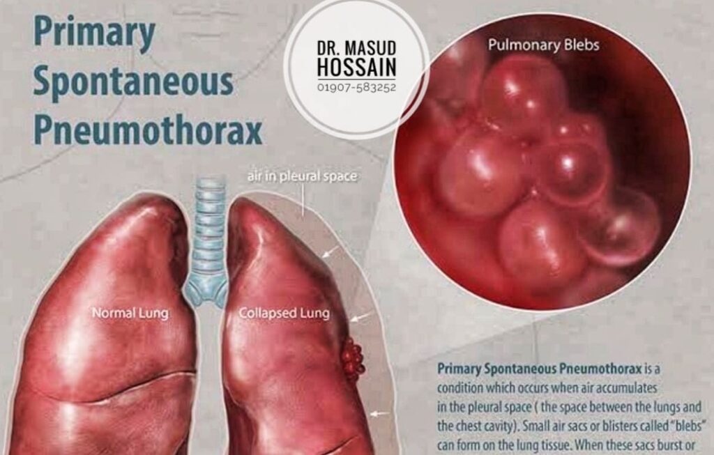 নিউমোথোরাক্স | Pneumothorax | ডাঃ মাসুদ হোসেন।