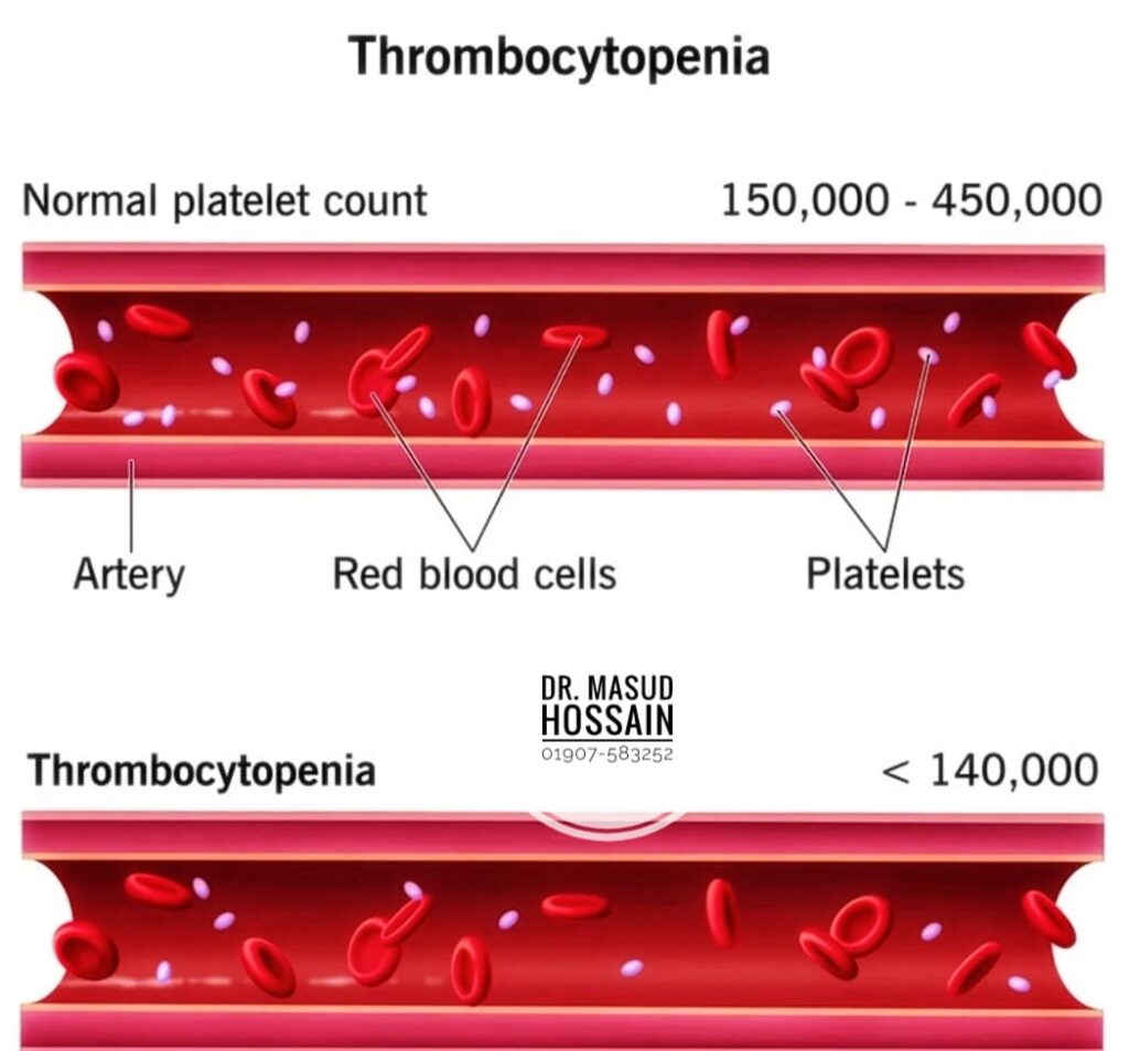 Thrombocytopenia | থ্রম্বোফ্লেবাইটিস | ডাঃ মাসুদ হোসেন।