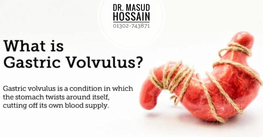 ভলভিউলাস | Volvulus | Dr. Masud Hossain.
