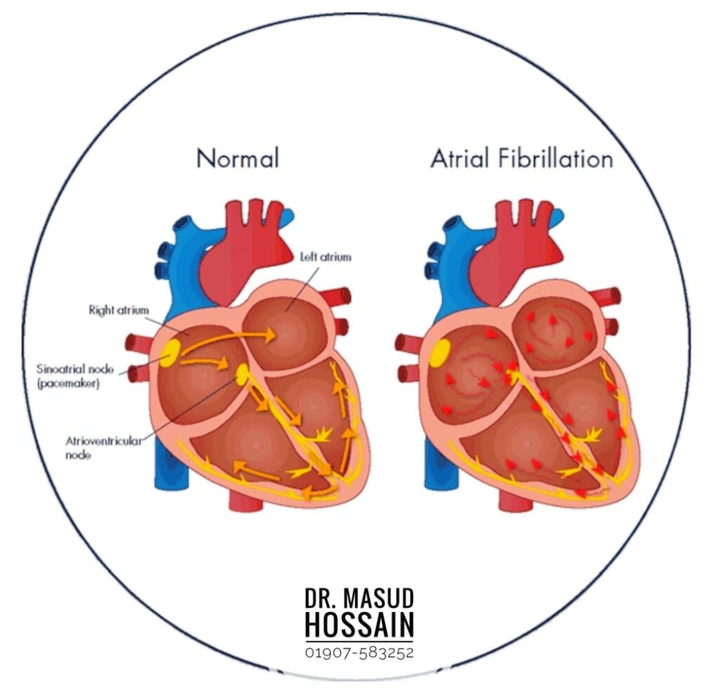 অ্যাট্রিয়াল ফিব্রিলেশন | Atrial Fibrillation | ডাঃ মাসুদ হোসেন।