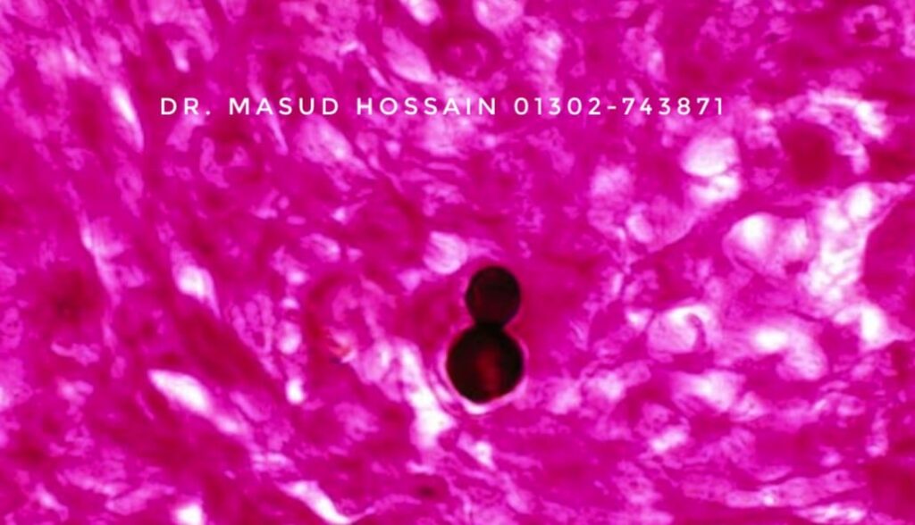 ব্লাস্টোমাইকোসিস | Blastomycosis | ডাঃ মাসুদ হোসেন।