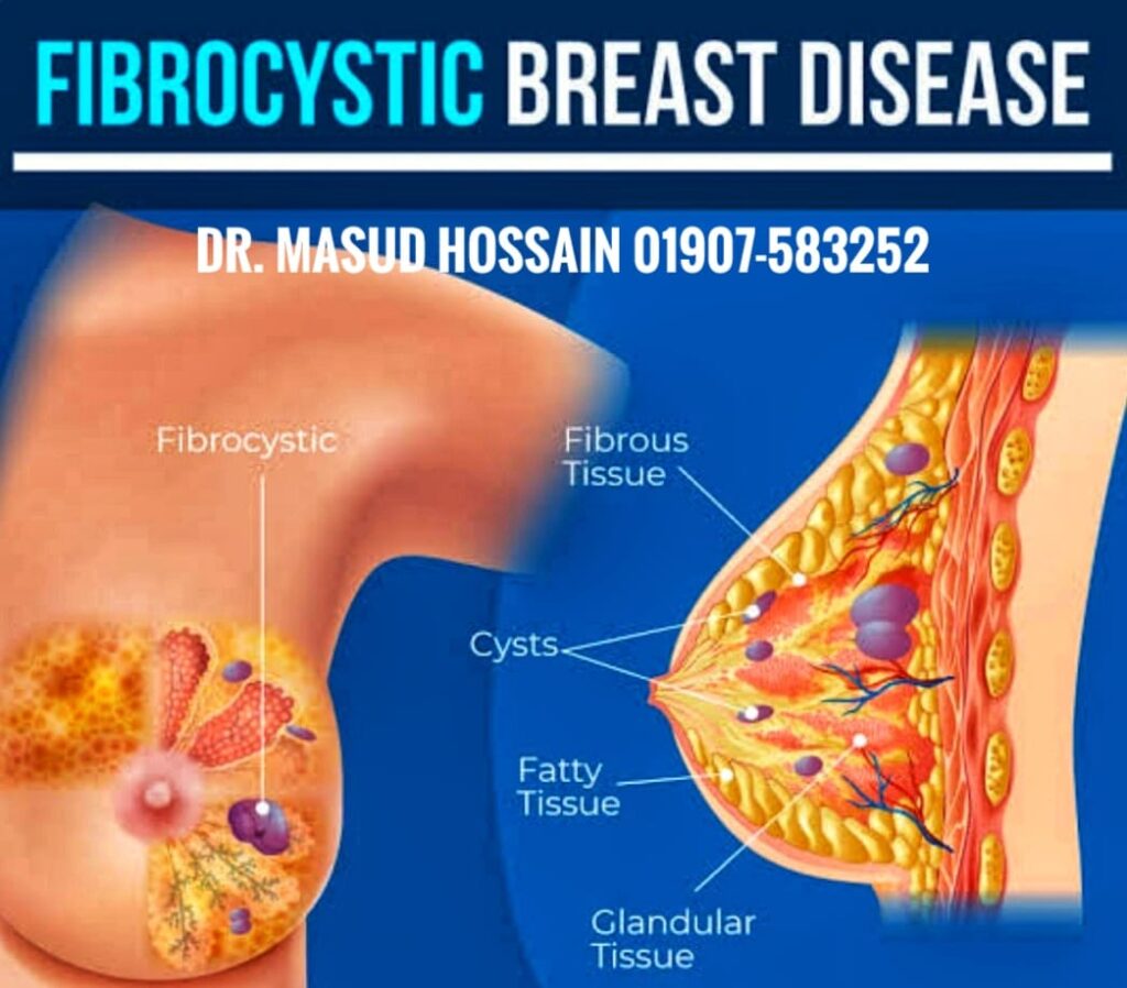 ফাইব্রোসিসটিক ব্রেস্ট ডিজিজ | Fibro Cystic Breast Disease