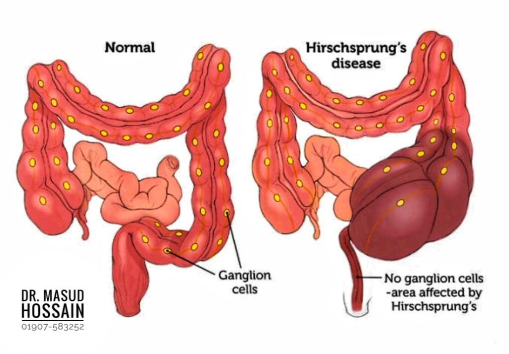 হার্শপ্রাং ডিজিজ | Hirschsprung Disease | Dr. Masud Hossain.