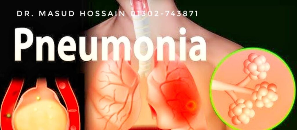 নিউমোনিয়ার ( Pneumonia ) হোমিও চিকিৎসা।