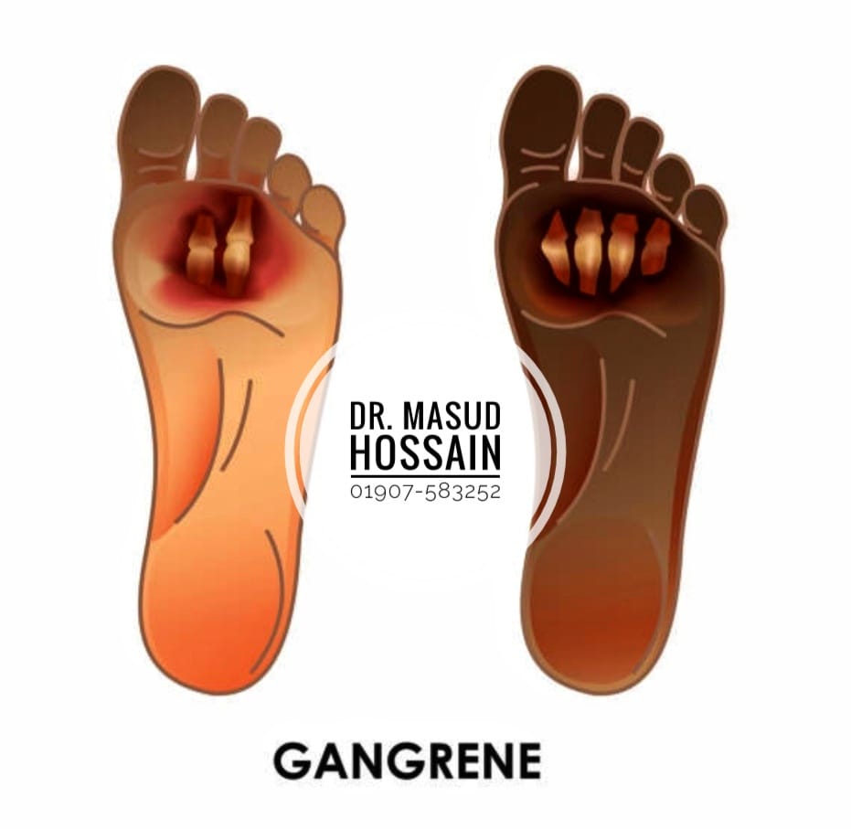 গ্যাস গ্যাংরিন | Gas Gangrene | ডাঃ মাসুদ হোসেন।