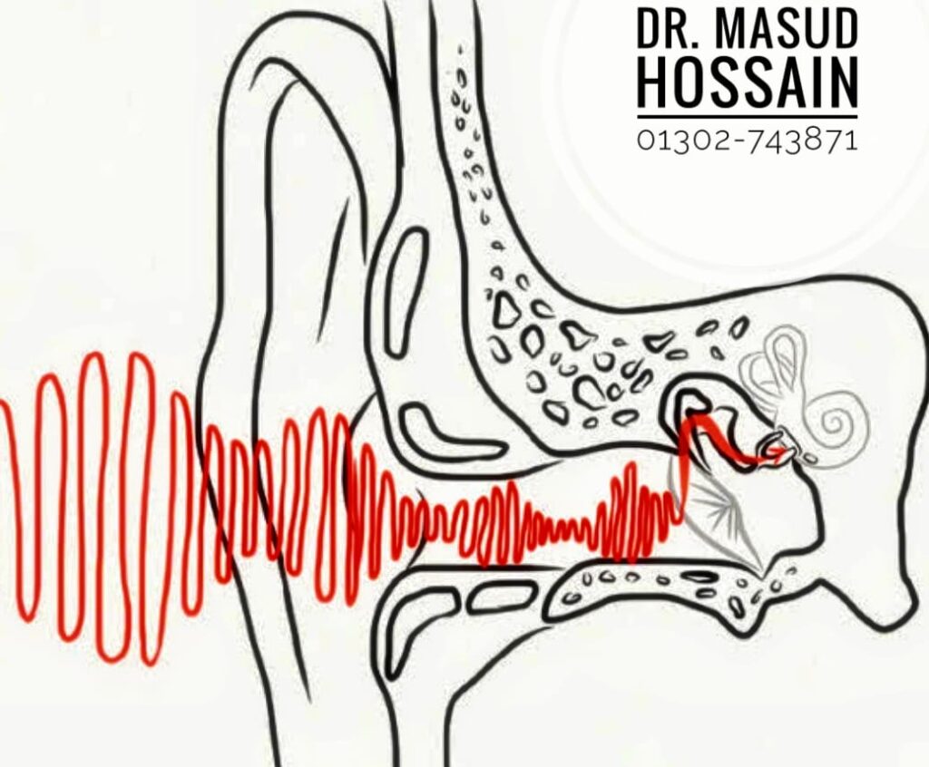 Conductive Hearing Loss | ডাঃ মাসুদ হোসেন। 3 Conductive Hearing Loss | ডাঃ মাসুদ হোসেন।