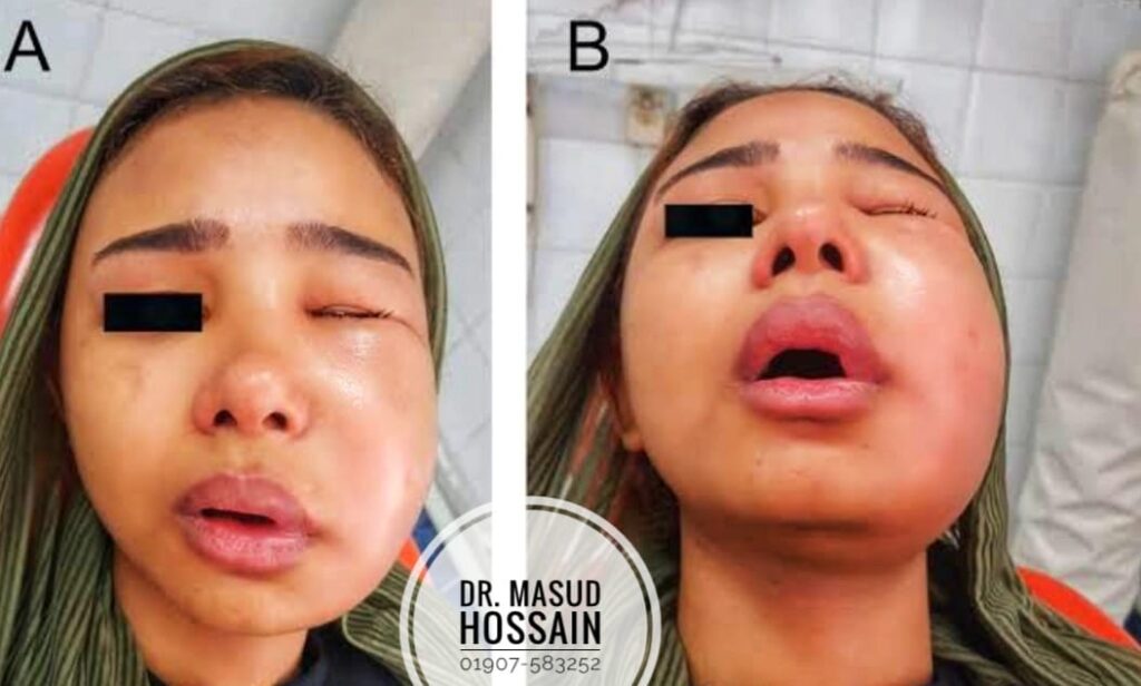 Cellulitis Or Abscess Of Mouth | ডাঃ মাসুদ হোসেন।