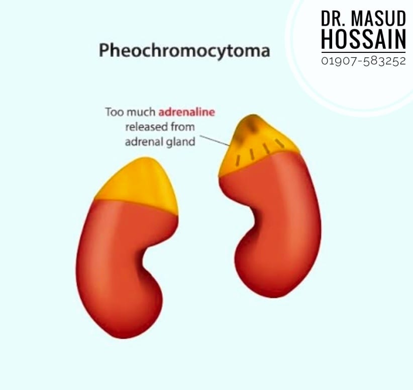 ফিওক্রোমোসাইটোমা- Pheochromocytoma Treatment