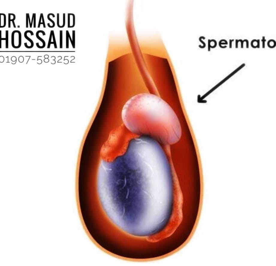 Epididymal Cyst ও Spermatocele এর হোমিওপ্যাথিক চিকিৎসা।
