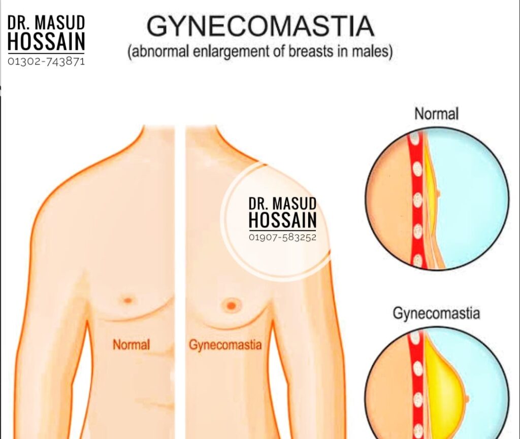 যেসব কারণে পুরুষের স্তন বড় হয়ে যায়!