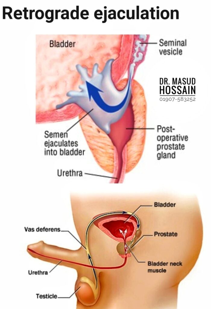 রেট্রোগ্রেড ইজাকুলেশন রোগের হোমিও চিকিৎসা।