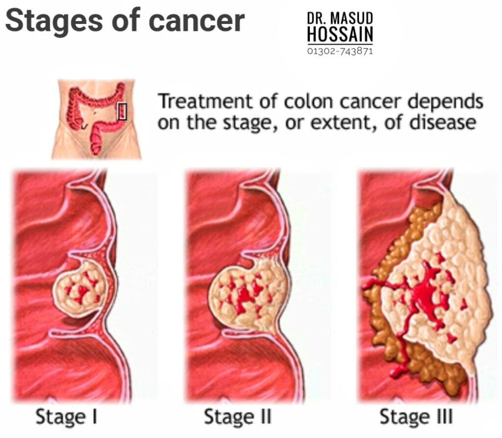 ক্যান্সার- Cancer হলে রোগী কতদিন বাঁচে ?