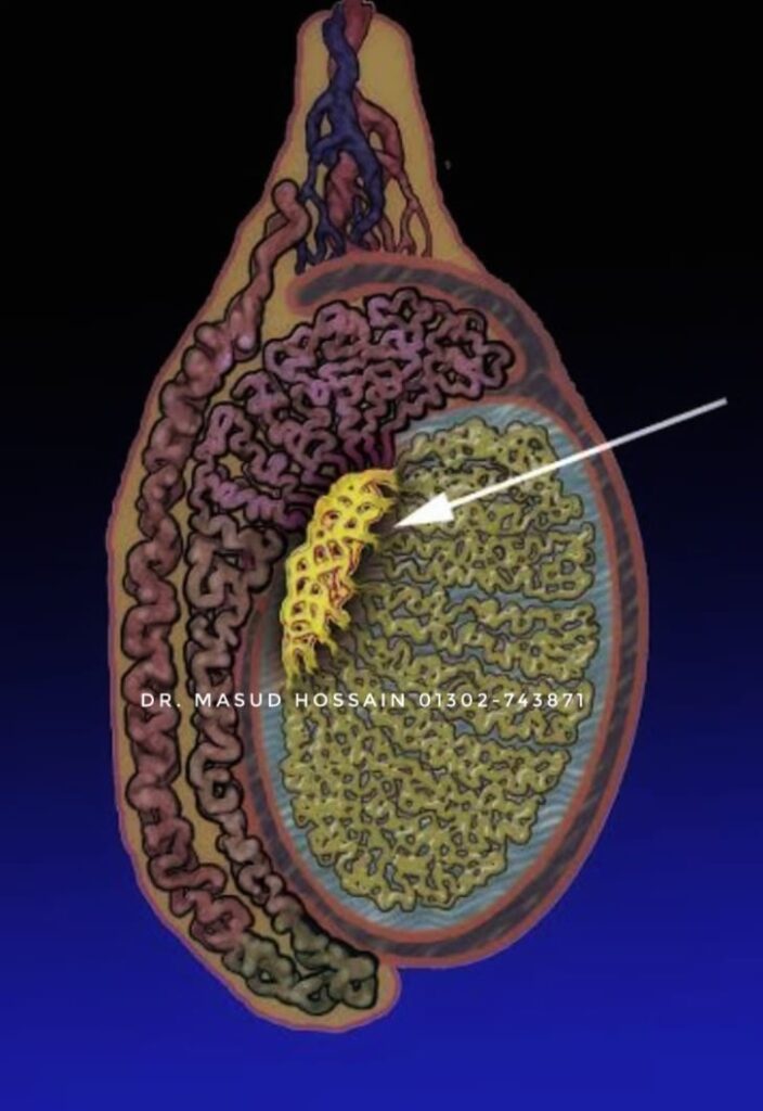 এপিডিডাইমিটিস (Epididymitis) | হোমিও বিশেষজ্ঞ চট্টগ্রাম।