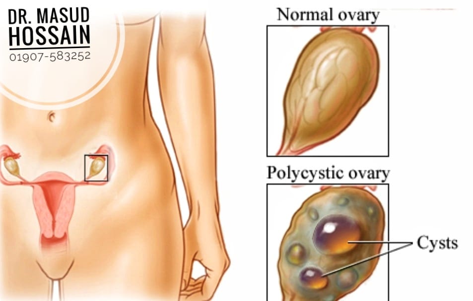ওভারির সিস্ট ও টিউমারের হোমিও চিকিৎসা | ডাঃ মাসুদ হোসেন।