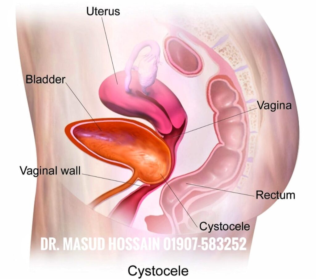 সিস্টোসেল ( মহিলাদের মূত্রথলি ফুলে যাওয়া ) সম্পর্কে বিস্তারিত তথ্য: